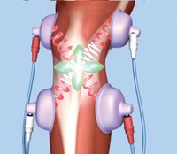 膝の電気治療