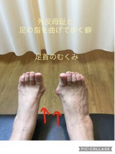 外反母趾