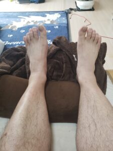 足の浮腫み