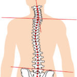 Spine distortion | 蕨重症専門 くまさんの整骨院 背骨歪み