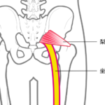 坐骨神経痛とは