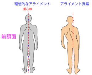 Back pain alignment | 蕨重症専門 くまさんの整骨院 腰痛アライメント