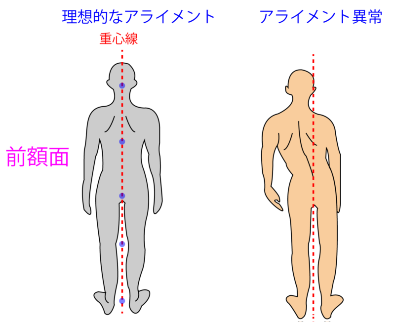 腰痛アライメント