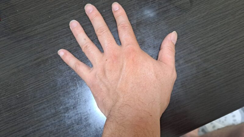 ばね指の手